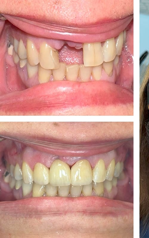 Dental Implants - Before treatment at Kentish Smiles