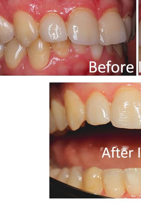 Invisalign - Before treatment at Kentish Smiles