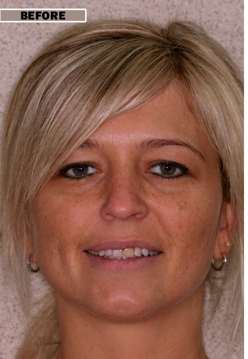 Teeth Whitening - Before treatment at Kentish Smiles